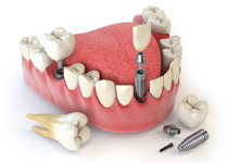 Implant Dentistry Menu